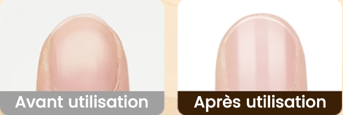 NailEase™ – Des ongles nets sans effort