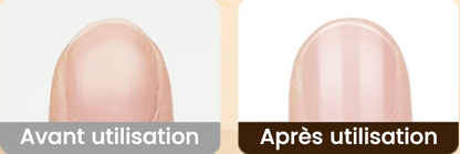 NailEase™ – Des ongles nets sans effort