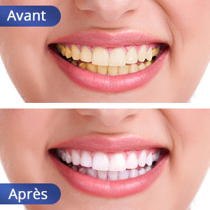 Blanchiment dentaire