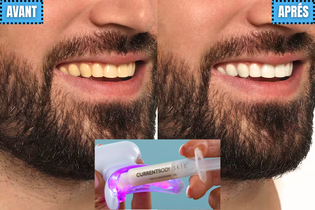 Blanchiment dentaire